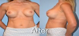 After breast procedure