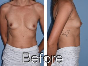 Before breast procedure