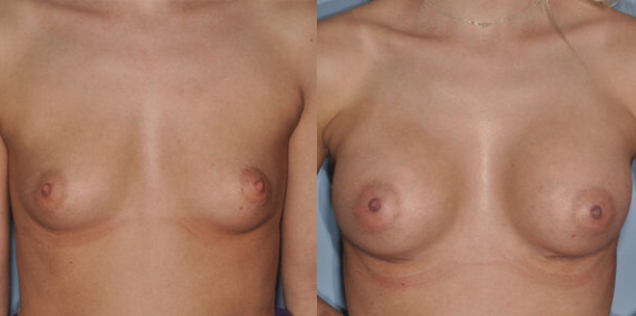 Woman's breasts