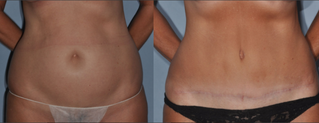 Woman's abdomen