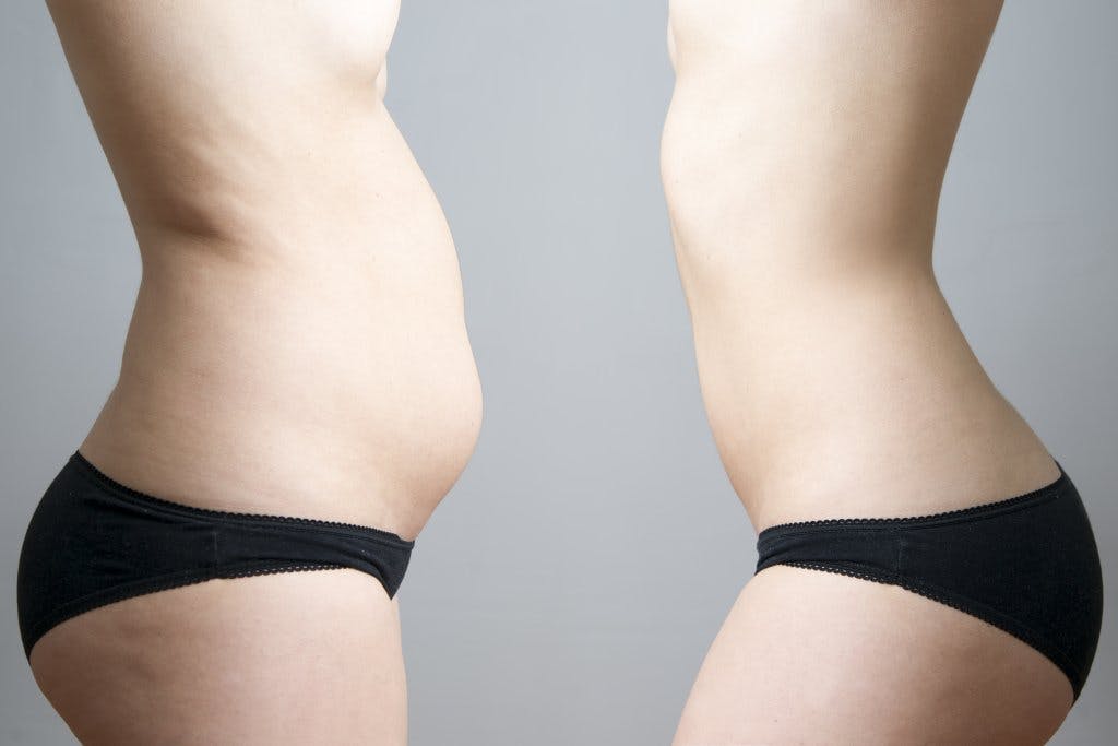 Side by side comparison of woman's abdomen
