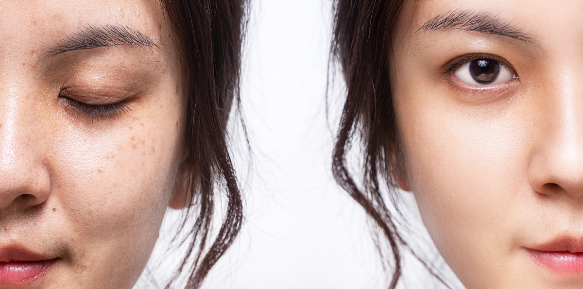 Side by side comparison on woman's face