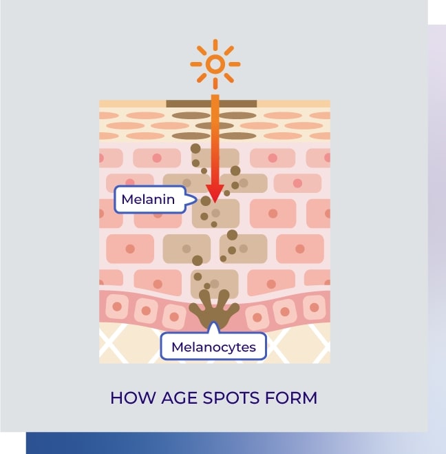 Infographic about age spots