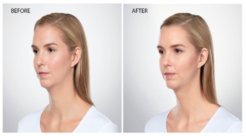patient before and after