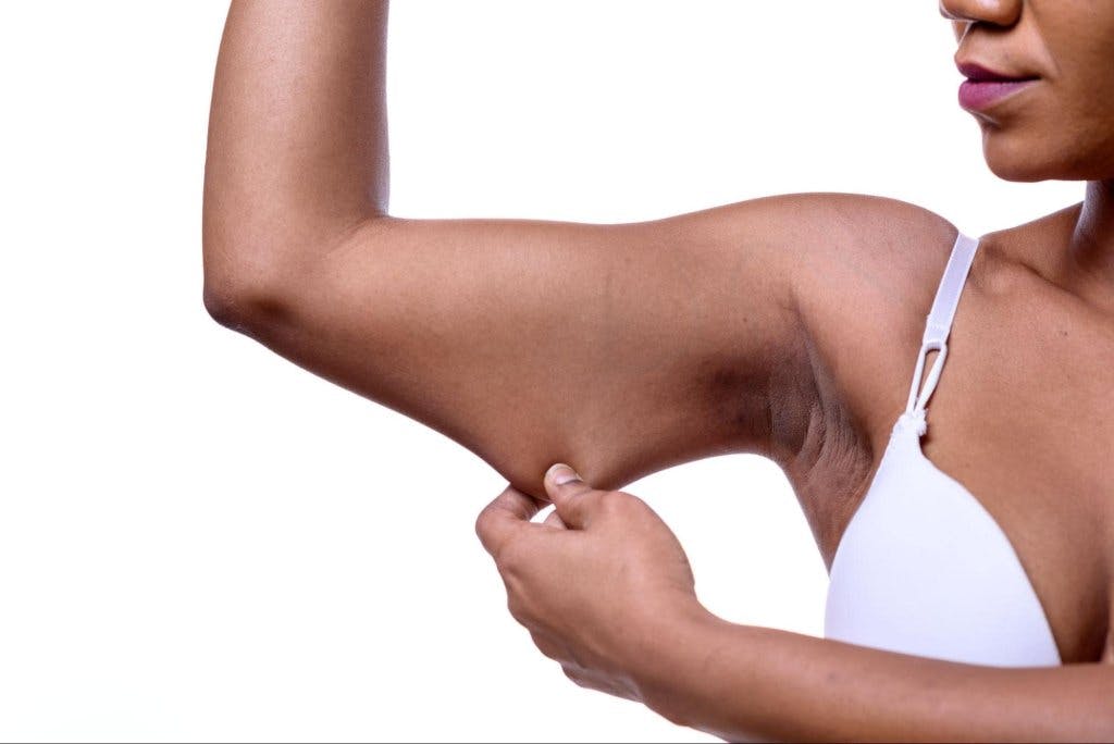 woman grabbing loose skin on her arm