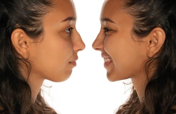 rhinoplasty results