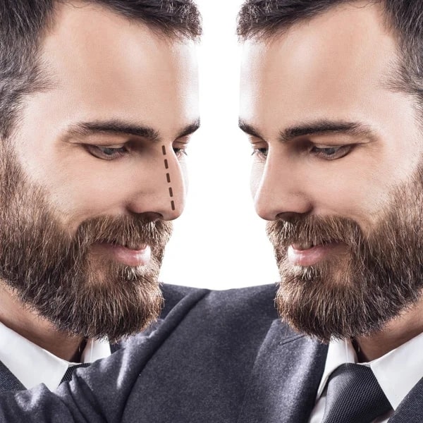 male rhinoplasty results