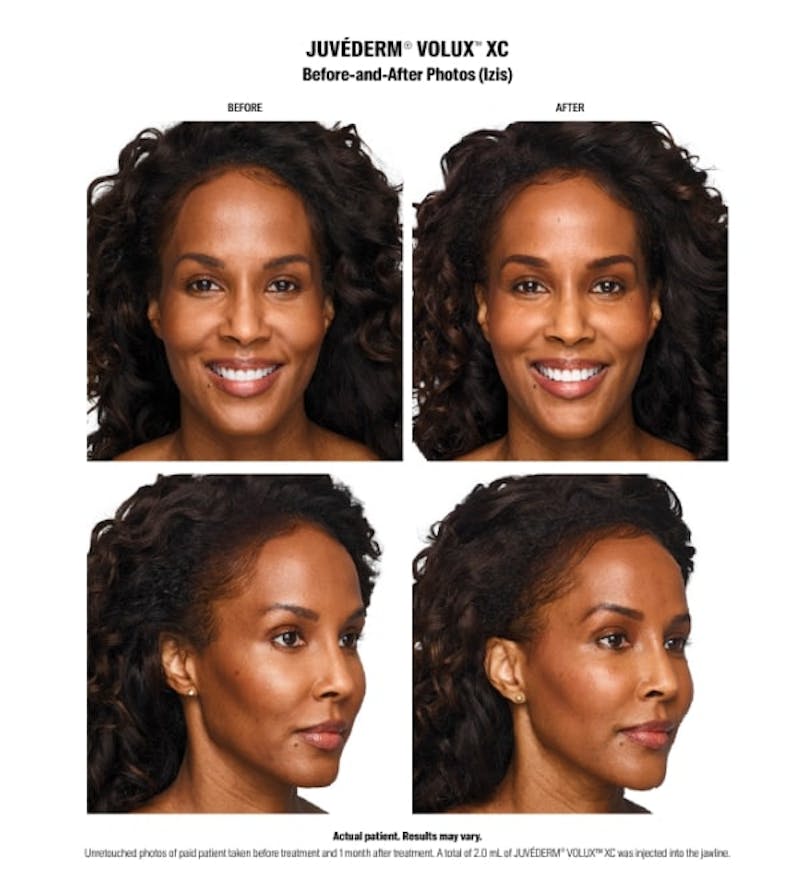juvederm results