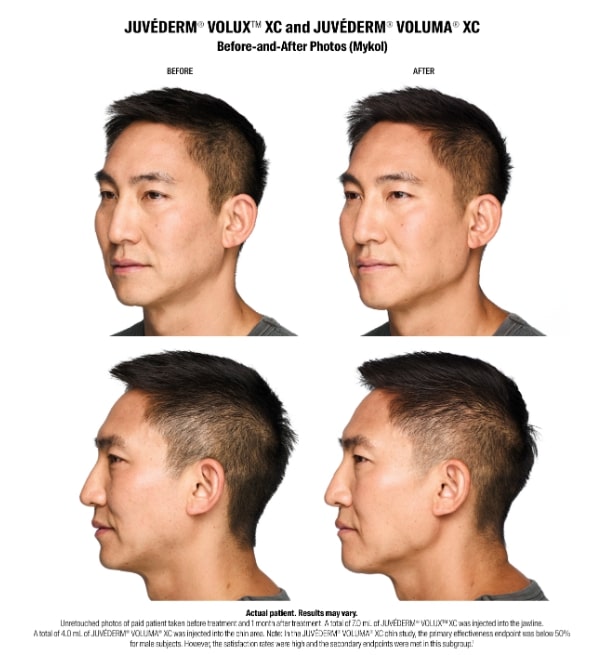 male juvederm results