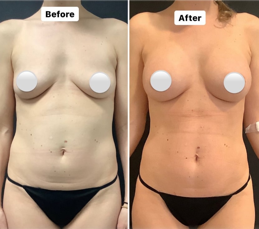 breast augmentation results