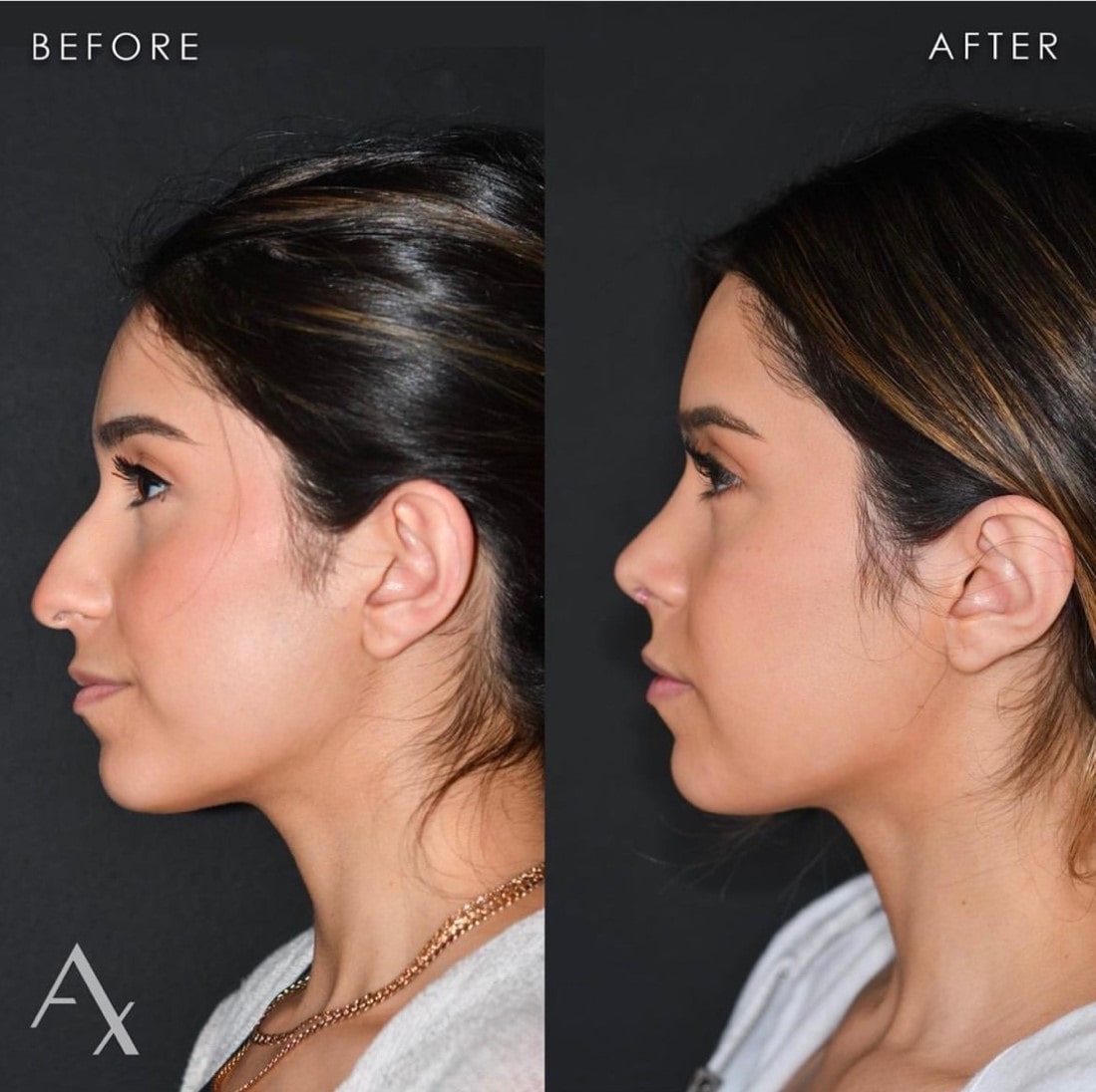 plastic surgery patient results