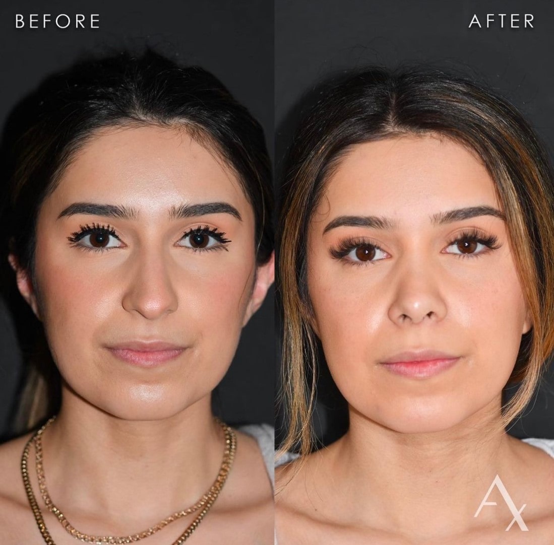 plastic surgery patient results