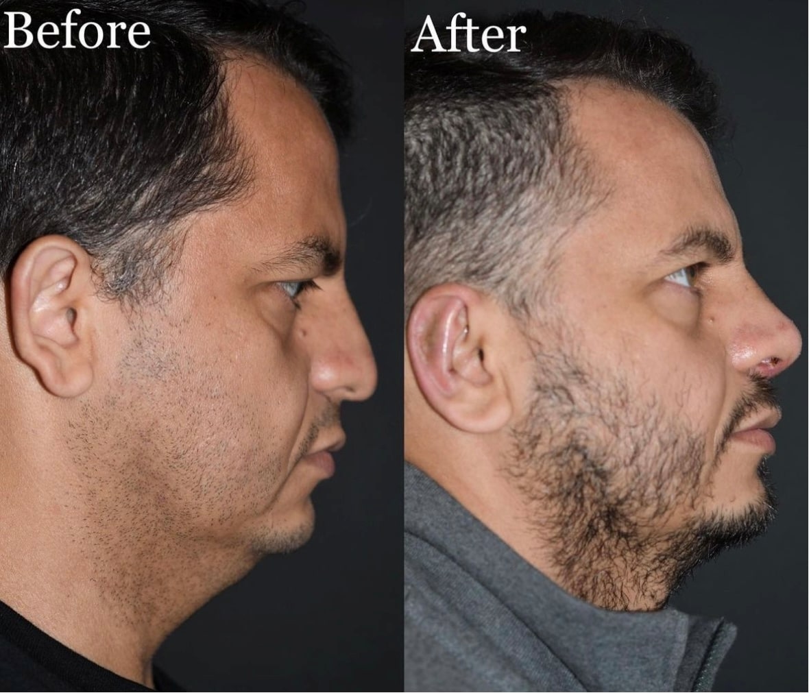 plastic surgery patient results