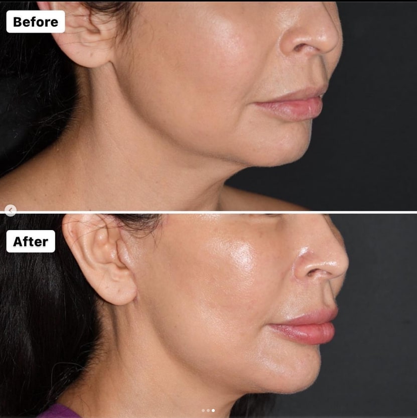 plastic surgery patient results