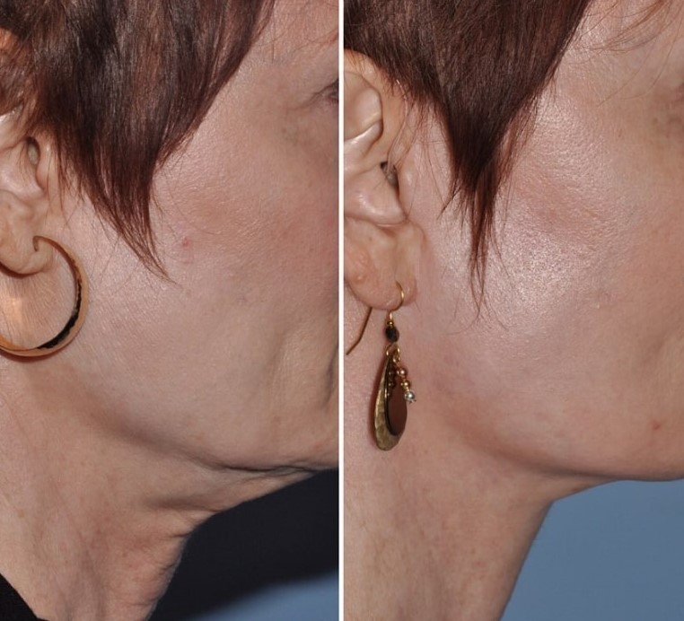 plastic surgery patient results