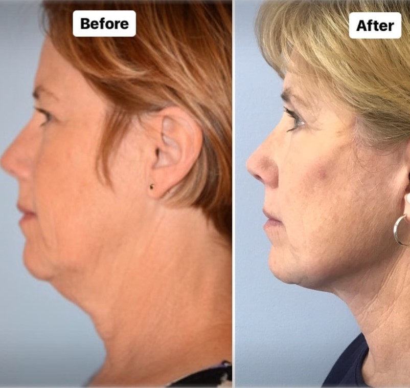 plastic surgery patient results