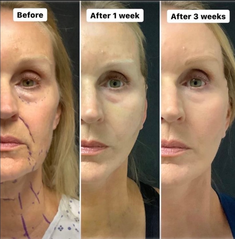 plastic surgery patient results