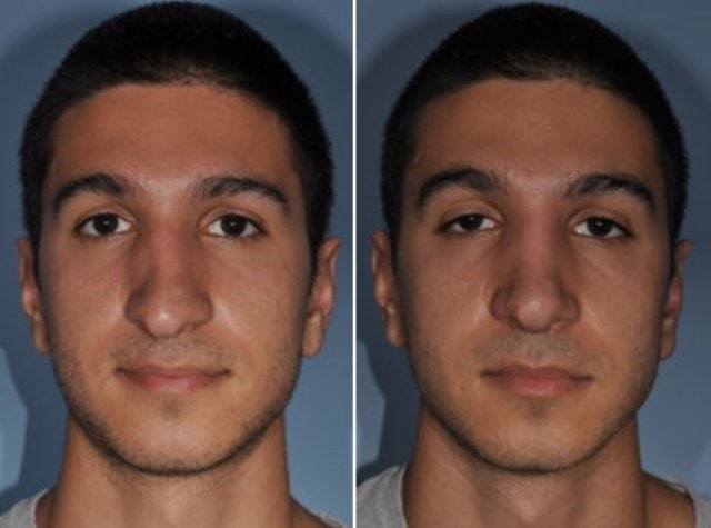 plastic surgery patient results