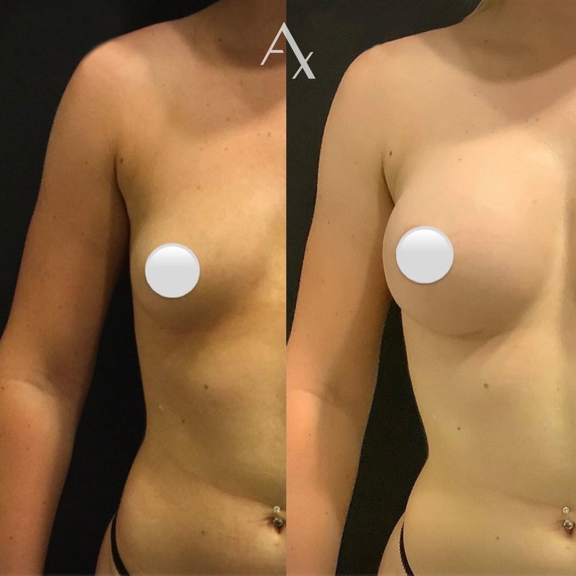 breast augmentation results