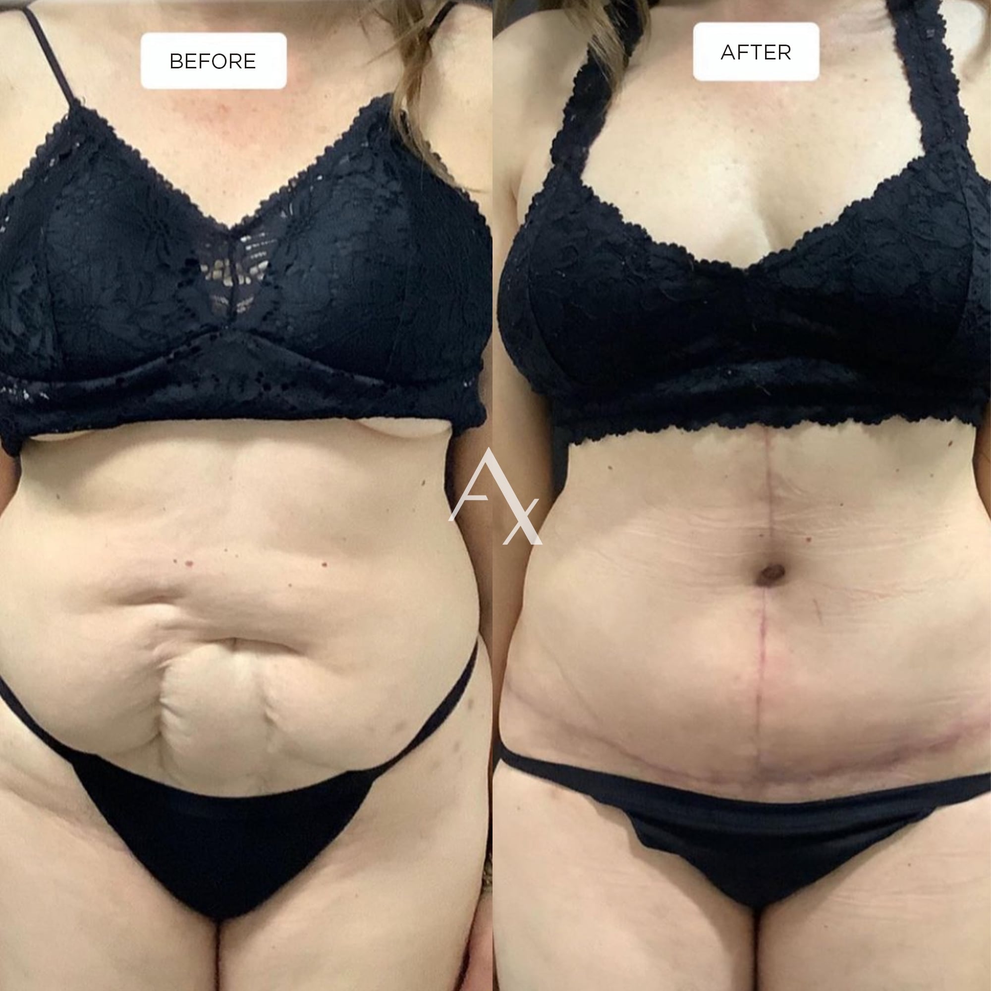 plastic surgery results