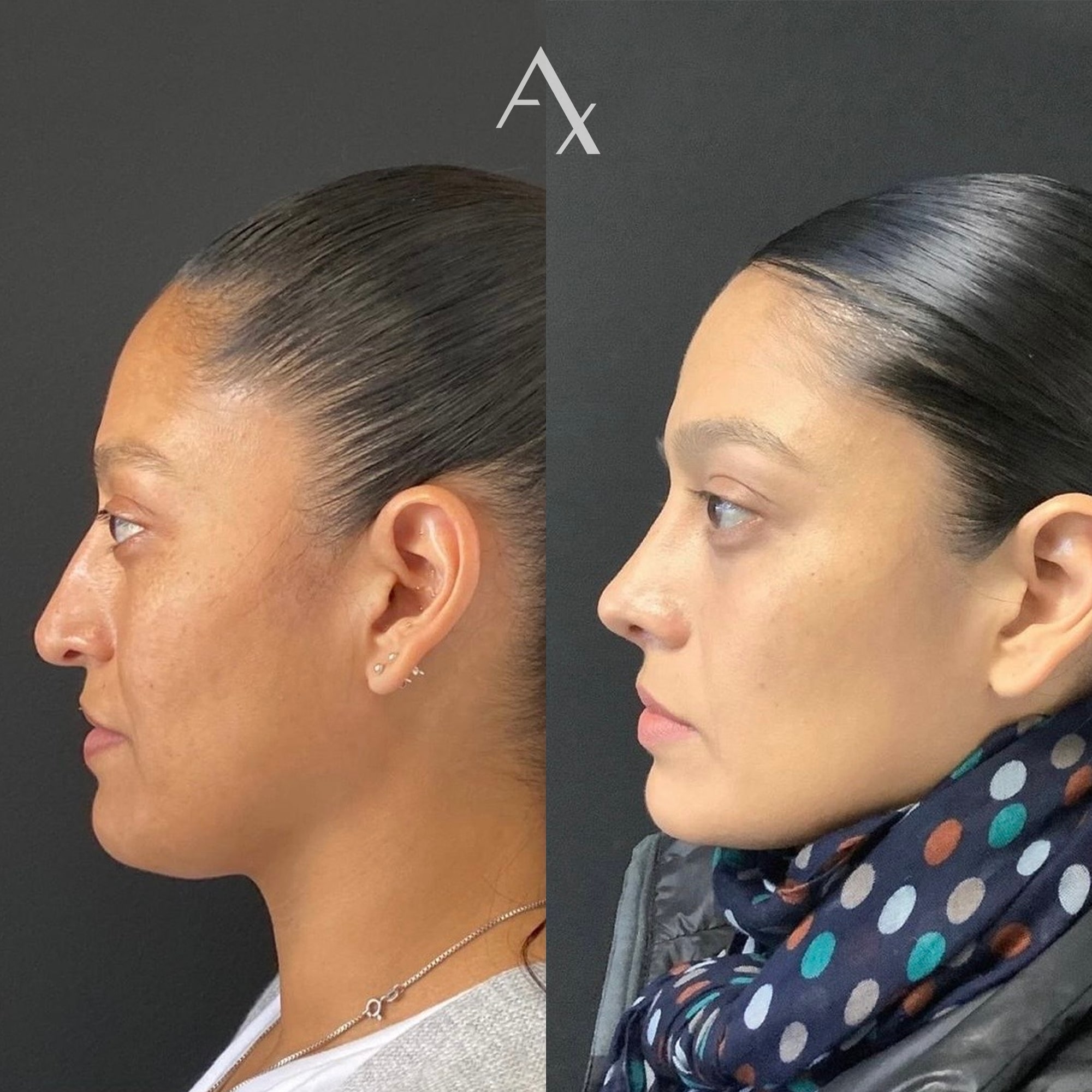 nose surgery results
