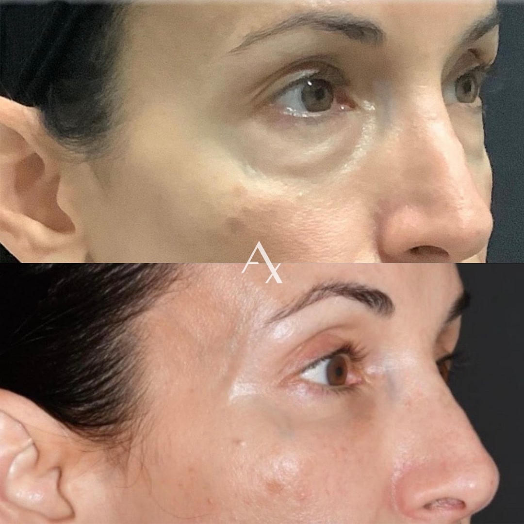 eyelid surgery results