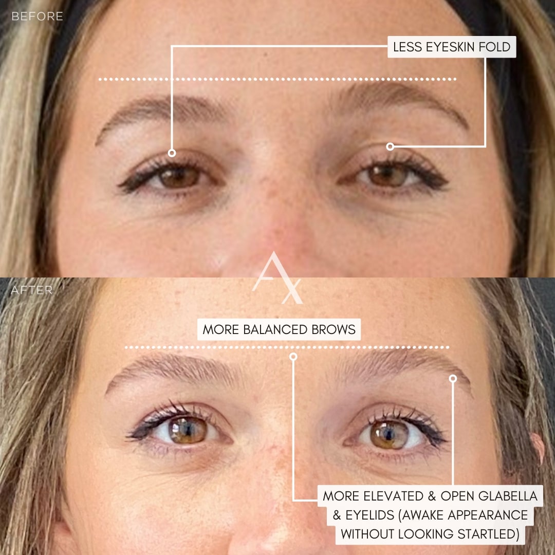 botox results