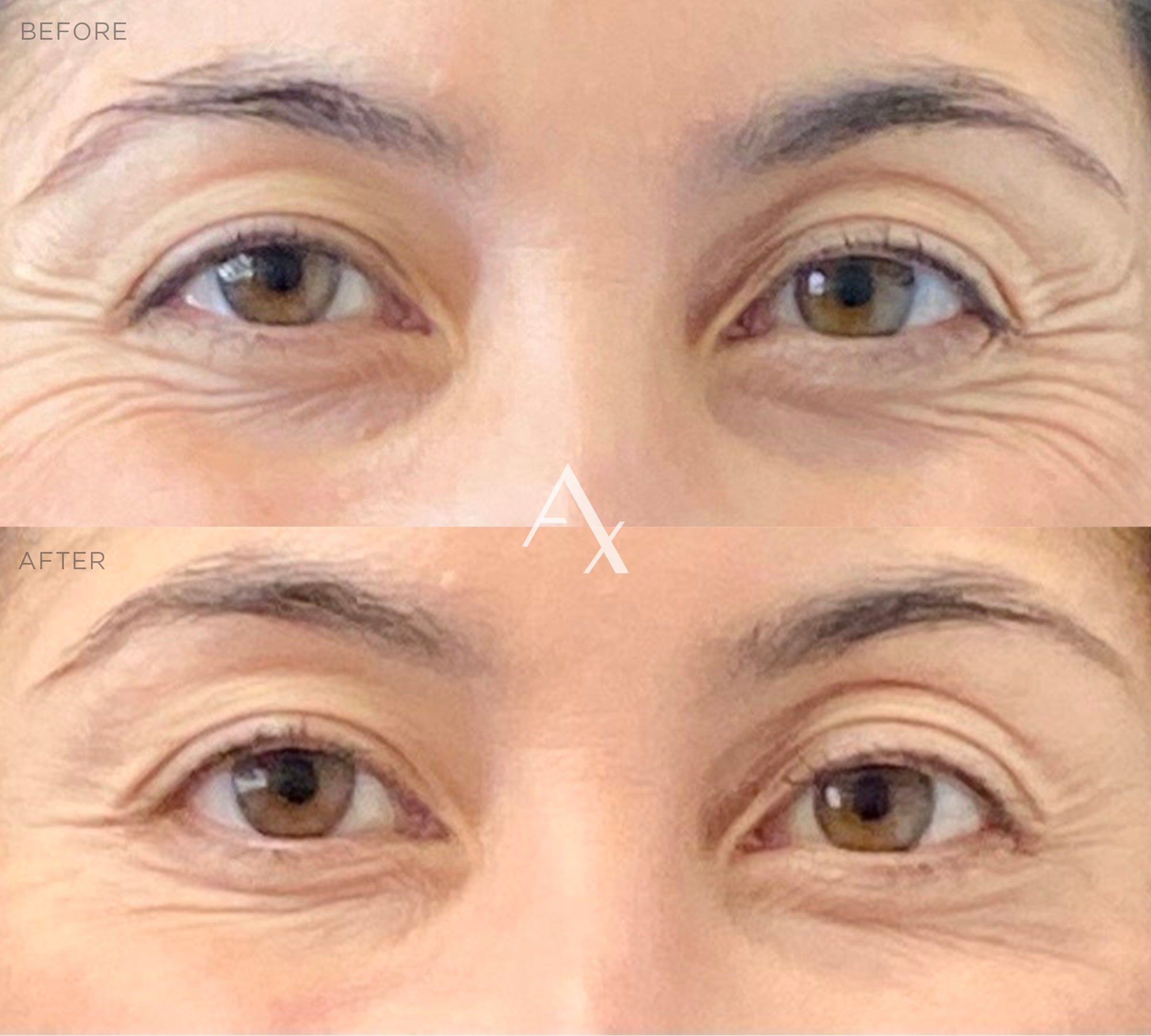 botox results