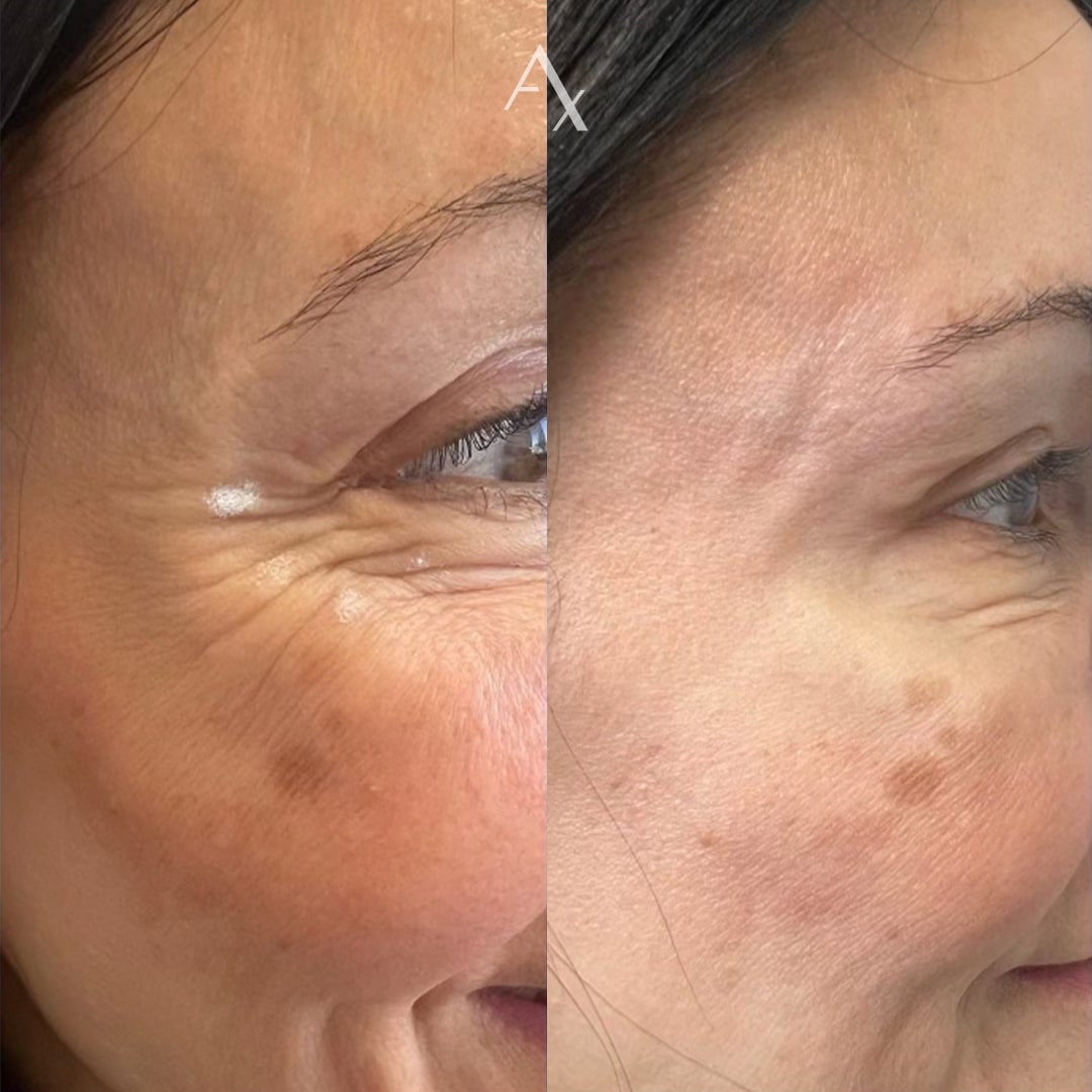 botox results