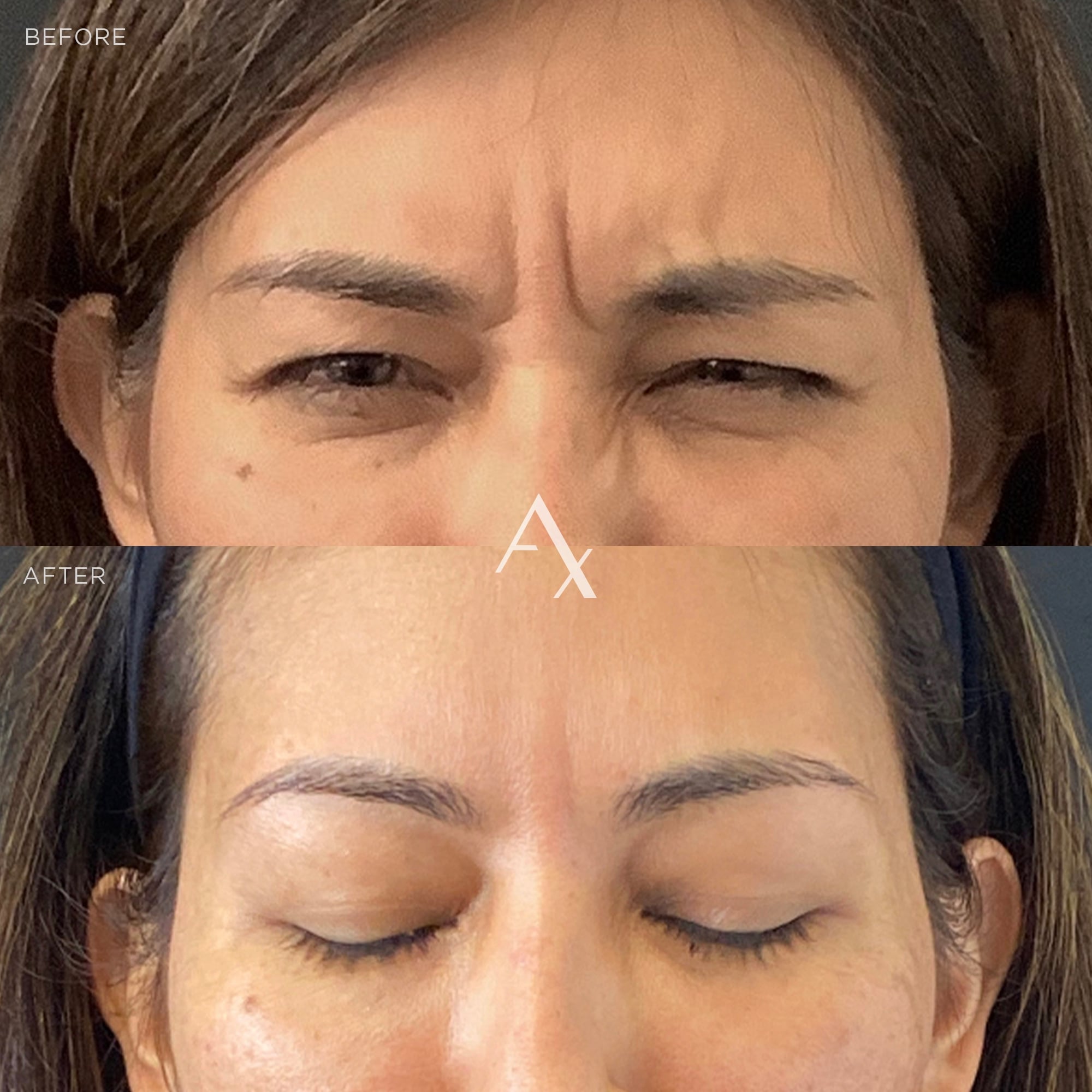 botox results