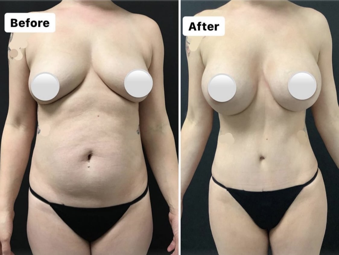 mommy makeover results