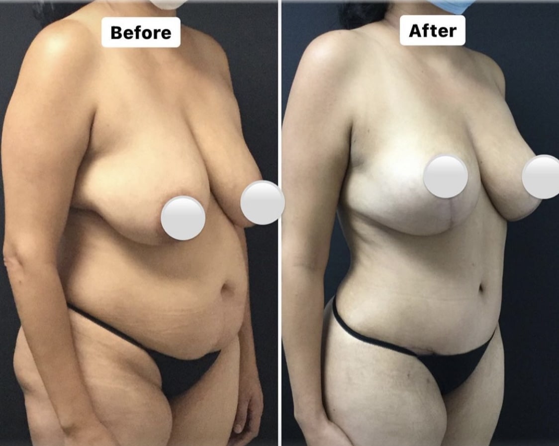 mommy makeover results