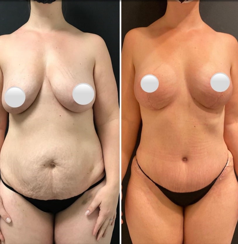mommy makeover results