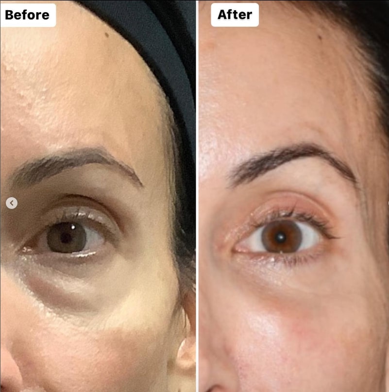 blepharoplasty results