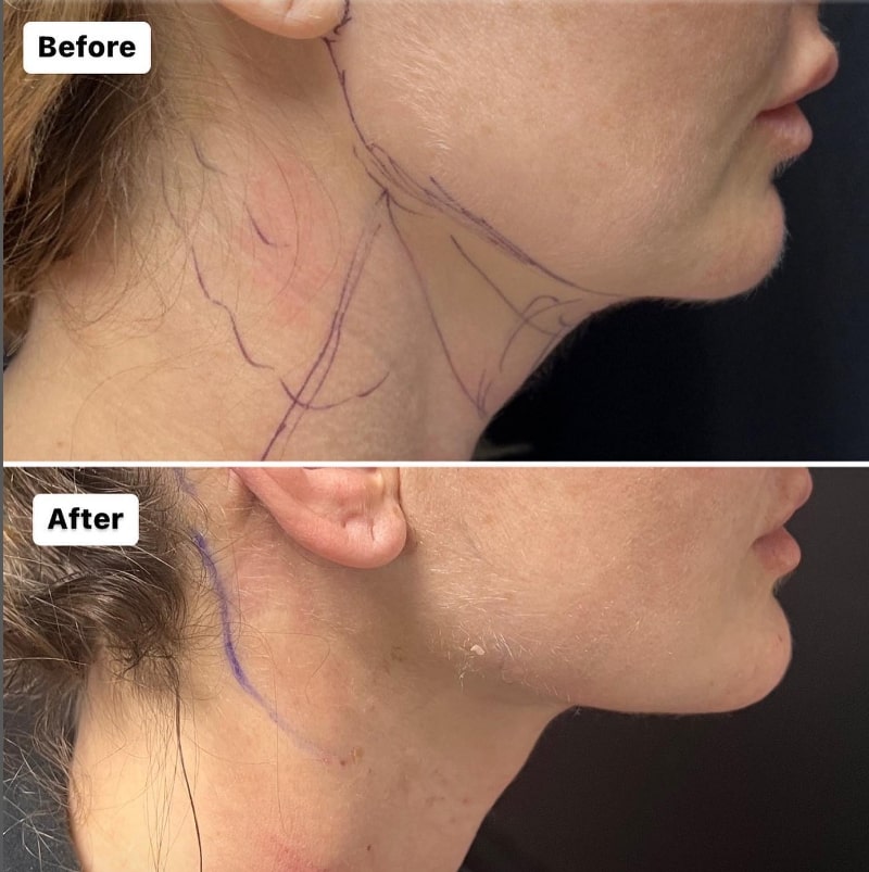 neck lift results