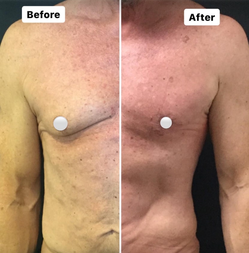 gynecomastia surgery results