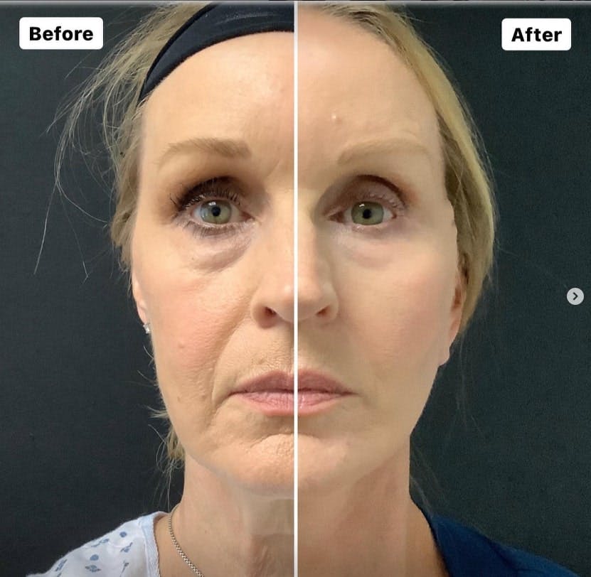 facelift results