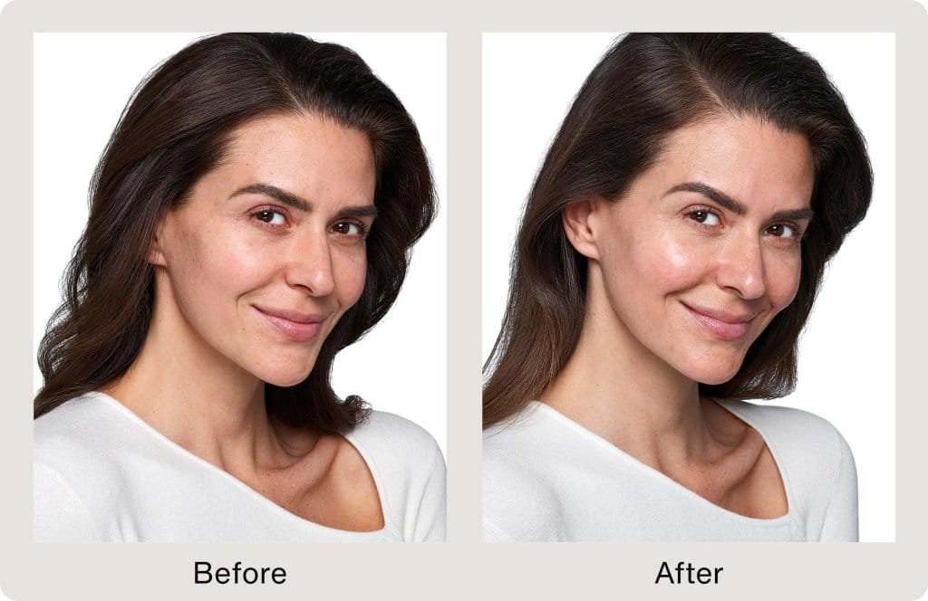 SKINVIVE™ by JUVÉDERM®