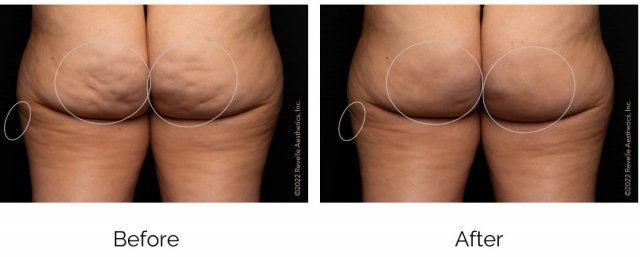 aveli results
