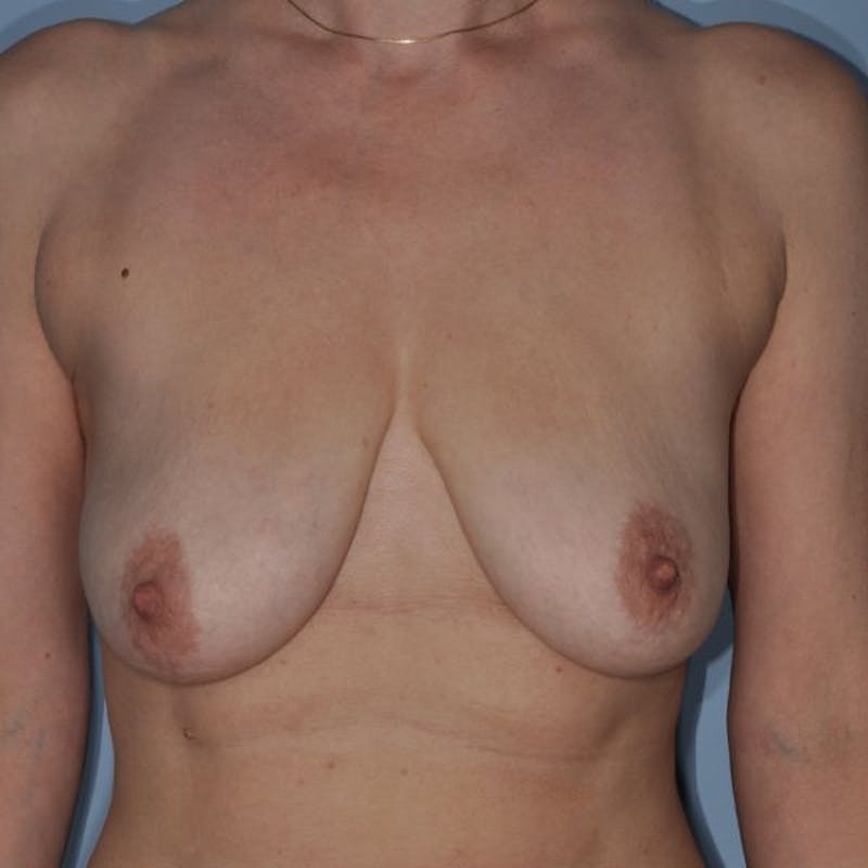 Breast Lift Before & After Gallery - Patient 370242 - Image 1