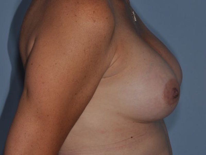 Breast Augmentation Before & After Gallery - Patient 410104 - Image 6