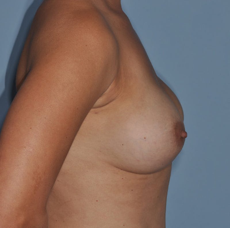 Breast Augmentation Before & After Gallery - Patient 341907 - Image 6