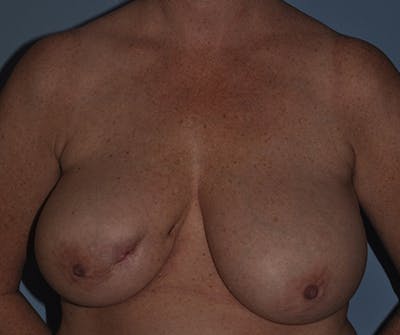 Breast Reconstruction Before & After Gallery - Patient 408921 - Image 1