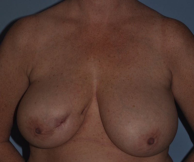 Breast Reconstruction Before & After Gallery - Patient 408921 - Image 1