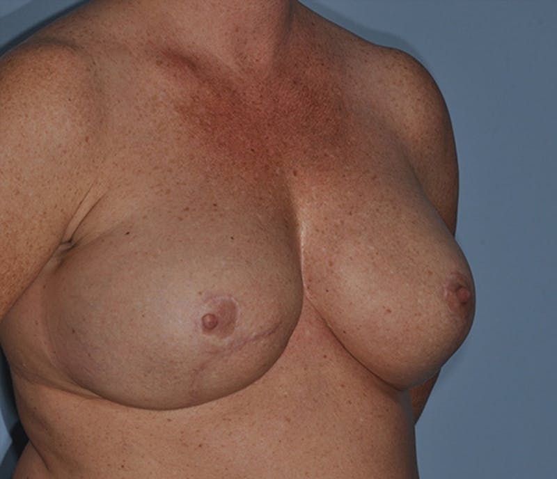 Breast Reconstruction Before & After Gallery - Patient 408921 - Image 4
