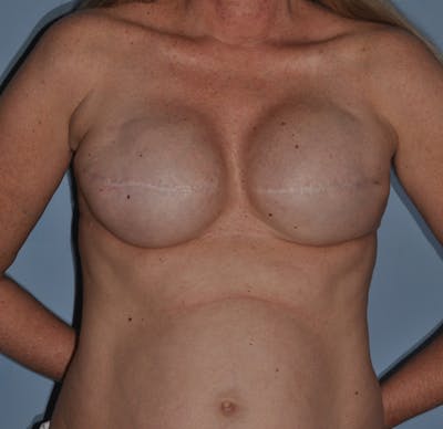 Breast Reconstruction Before & After Gallery - Patient 258659 - Image 1