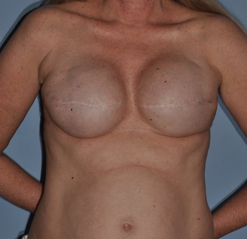 Breast Reconstruction Before & After Gallery - Patient 258659 - Image 1