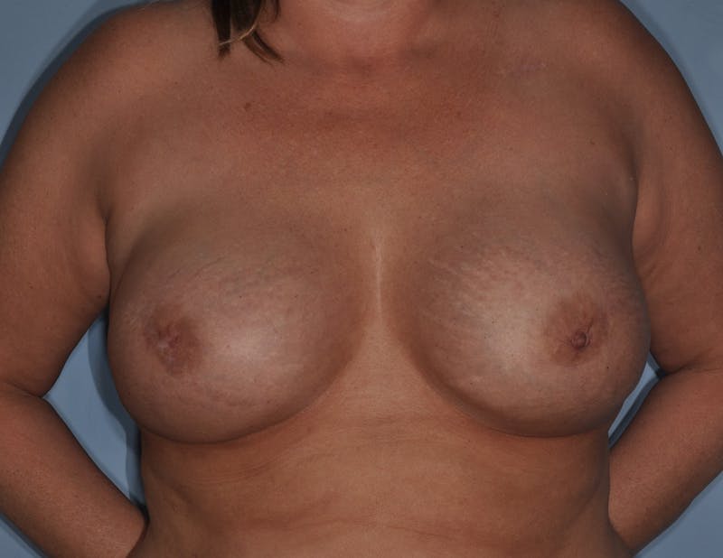 Breast Reconstruction Before & After Gallery - Patient 186162 - Image 1