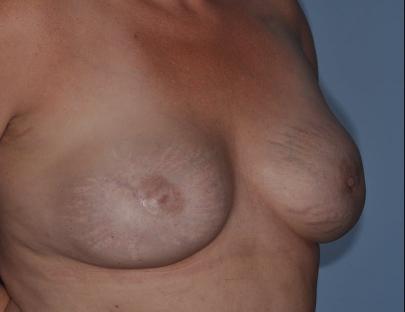 Breast Reconstruction Before & After Gallery - Patient 186162 - Image 4
