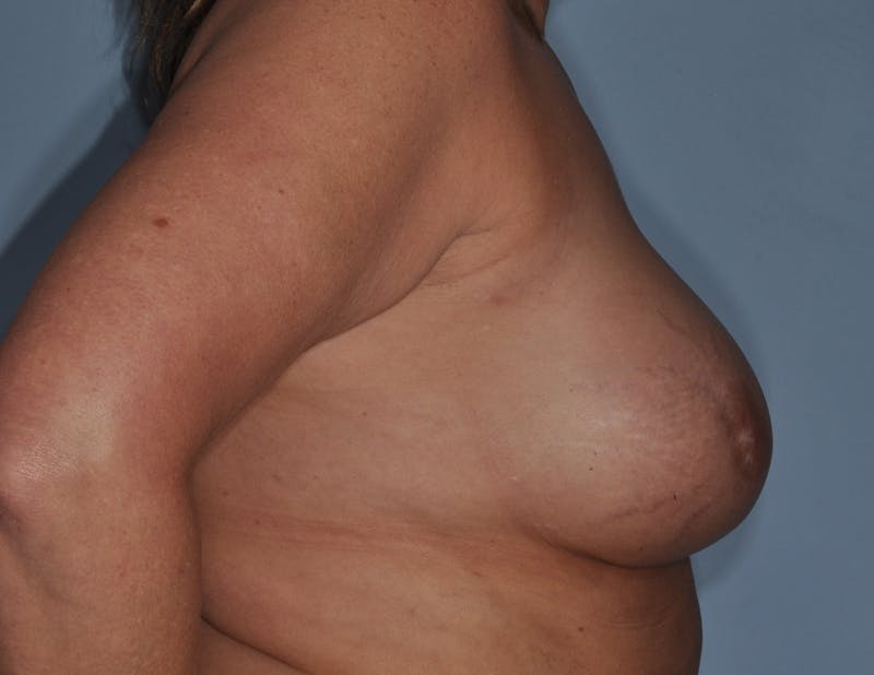 Breast Reconstruction Before & After Gallery - Patient 186162 - Image 5